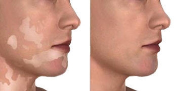 Vitiligo Tedavisi